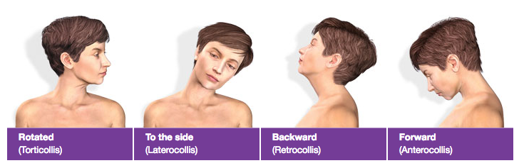 Cerviccal Dystonia